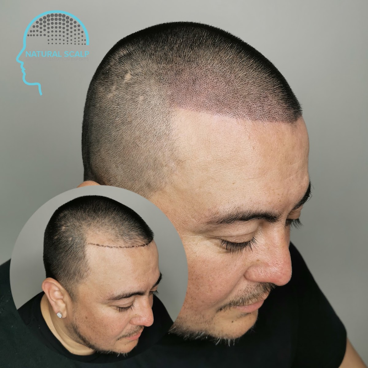 Natural Scalp