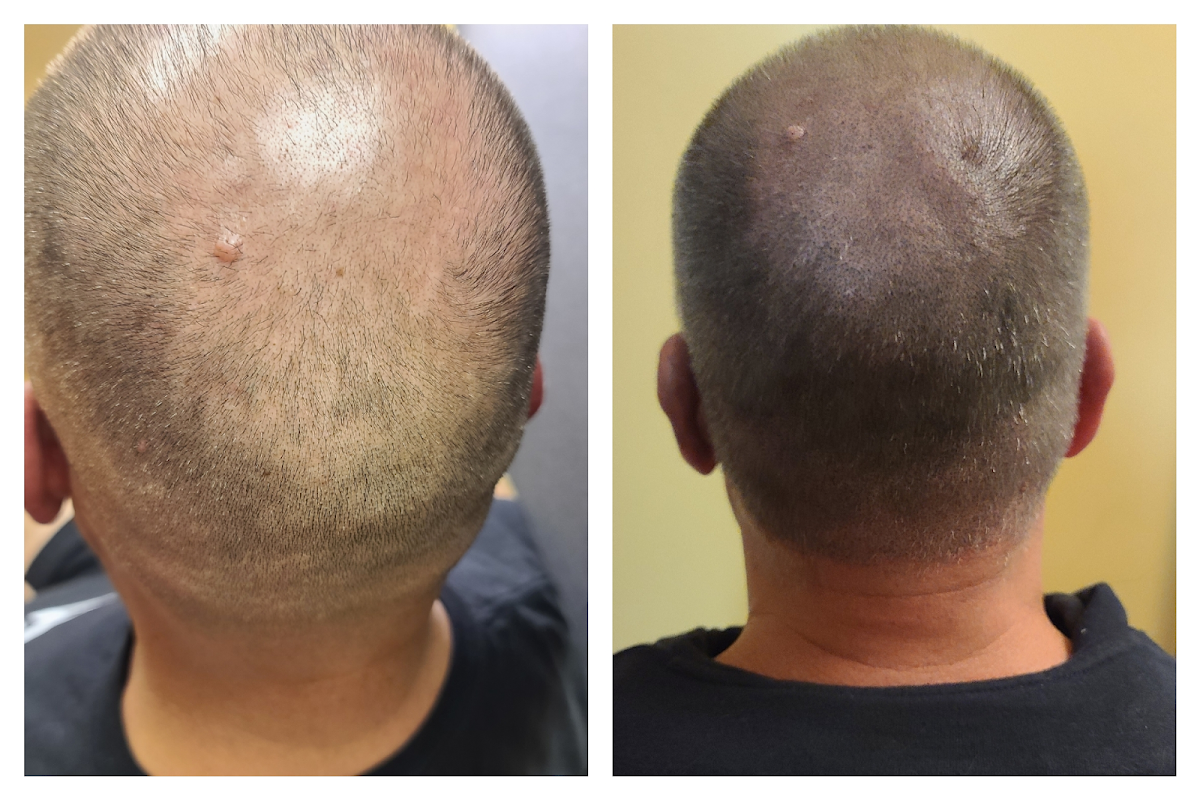 Ink-credible Scalp Micropigmentation